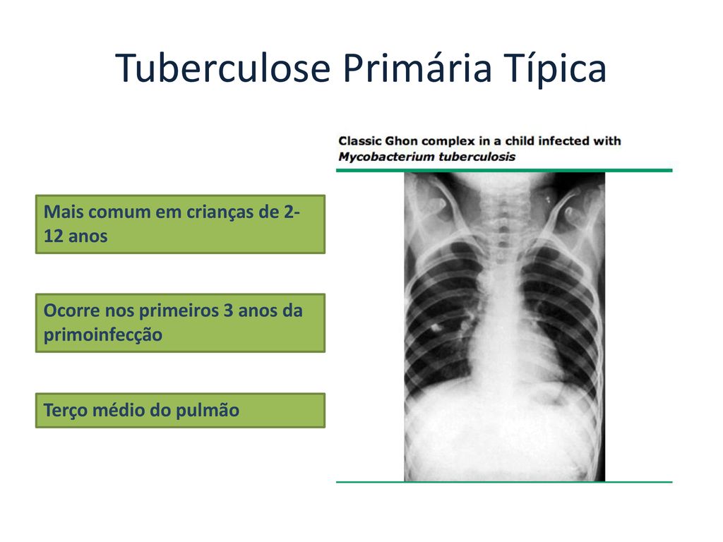 Tuberculose Hospital Materno Infantil De Bras Lia Ppt Carregar